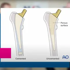 Ilustracja porównująca endoprotezę cementowaną i bezcementową stawu biodrowego.
