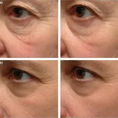 Retinol lek na co? Odkryj jego skutki i zastosowania w terapii skóry