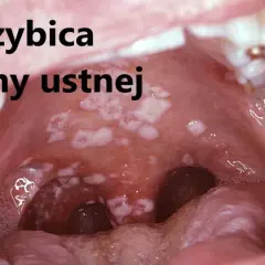 Skuteczne leki na grzybicę jamy ustnej - uniknij bólu i dyskomfortu