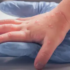 Dziecięca dłoń z licznymi pęcherzykami, objawem wysypki alergicznej, spoczywa na niebieskiej rękawiczce.