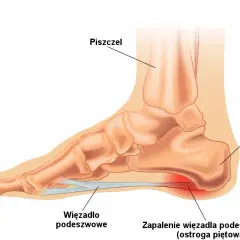 Jakie leki na ostrogę piętową skutecznie złagodzą ból?