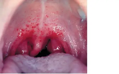 Gardło z licznymi czerwonymi wybroczynami, objaw infekcji Streptococcus pyogenes.