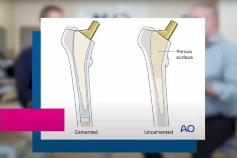 Ilustracja porównująca endoprotezę cementowaną i bezcementową stawu biodrowego.