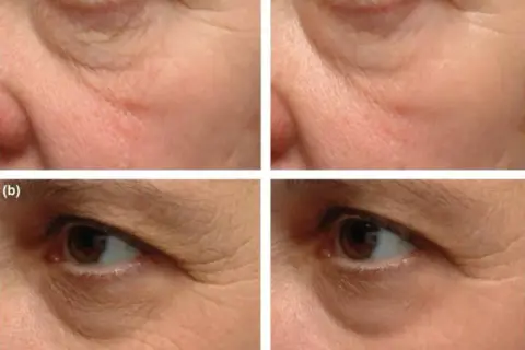Retinol lek na co? Odkryj jego skutki i zastosowania w terapii skóry