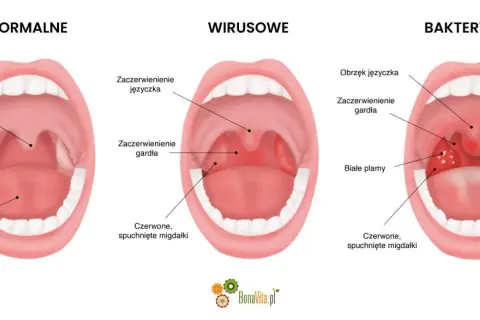 Porównanie gardła: normalne, wirusowe i bakteryjne. Czy angina jest zaraźliwa? Obraz pokazuje różnice w wyglądzie migdałków i gardła przy infekcjach.