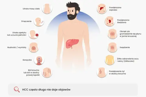 Ilustracja przedstawia objawy raka wątroby: utratę masy ciała, zmęczenie, nudności, gorączkę, powiększoną wątrobę, obrzęk brzucha, swędzenie i żółtaczkę.