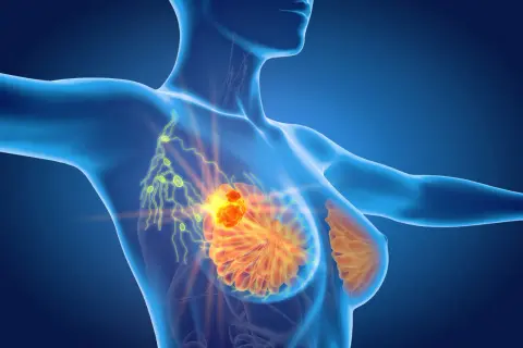 Anatomical rendering showing a tumor in the breast and enlarged lymph nodes in the armpit, indicating potential spread and causing ból pod pachą.