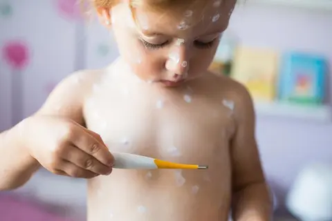 Jakie leki na ospę wietrzną skutecznie łagodzą objawy choroby?
