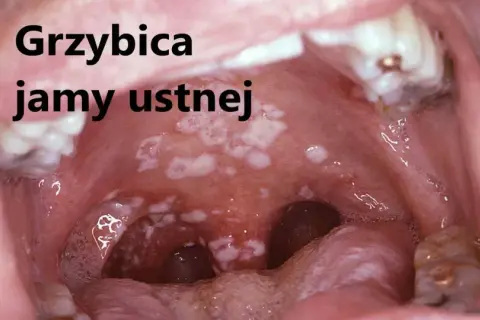 Skuteczne leki na grzybicę jamy ustnej - uniknij bólu i dyskomfortu