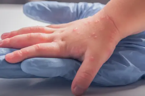 Dziecięca dłoń z licznymi pęcherzykami, objawem wysypki alergicznej, spoczywa na niebieskiej rękawiczce.