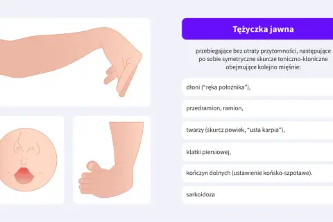 Ilustracja pokazuje tężyczkę jawną, objawy obejmują dłoń jak u położnika, skurcze twarzy i kończyn.