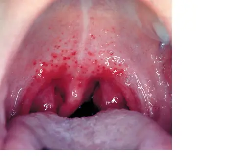 Gardło z licznymi czerwonymi wybroczynami, objaw infekcji Streptococcus pyogenes.