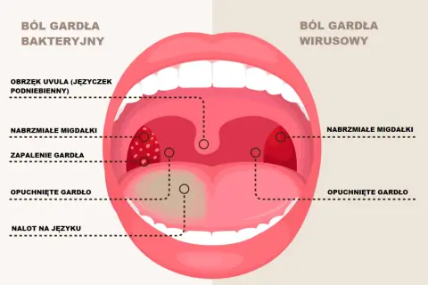 Porównanie bólu gardła: bakteryjnego (obrzęk języczka, zapalenie gardła, nalot na języku) i wirusowego (nabrzmiałe migdałki, opuchnięte gardło).