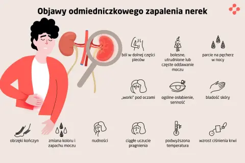 Ilustracja przedstawia objawy zapalenia nerek: ból pleców, problemy z oddawaniem moczu, obrzęki, nudności, gorączkę i inne.