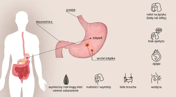 Ilustracja przedstawia objawy wrzodów żołądka: nalot na języku, brak apetytu, zgaga, bóle brzucha, wzdęcia, wymioty.