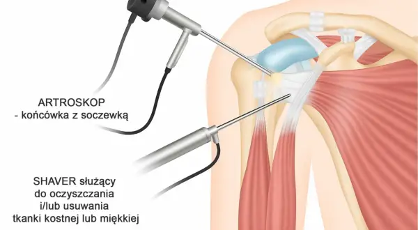 Artroskopia barku: narzędzia do leczenia bólu barku. Artroskop i shaver pracują w stawie, by usunąć uszkodzoną tkankę.