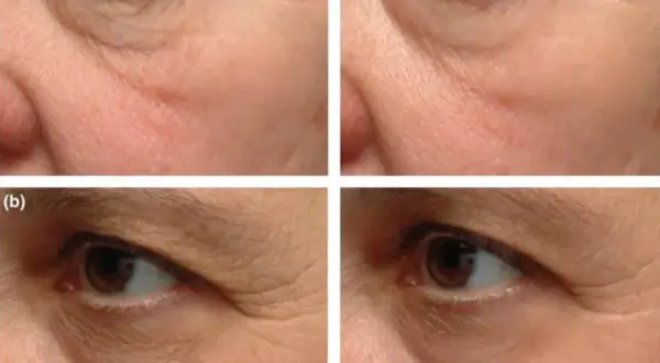 Retinol lek na co? Odkryj jego skutki i zastosowania w terapii skóry