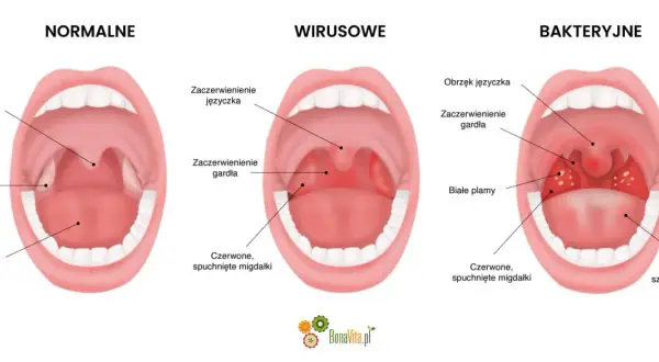 Porównanie gardła: normalne, wirusowe i bakteryjne. Czy angina jest zaraźliwa? Obraz pokazuje różnice w wyglądzie migdałków i gardła przy infekcjach.