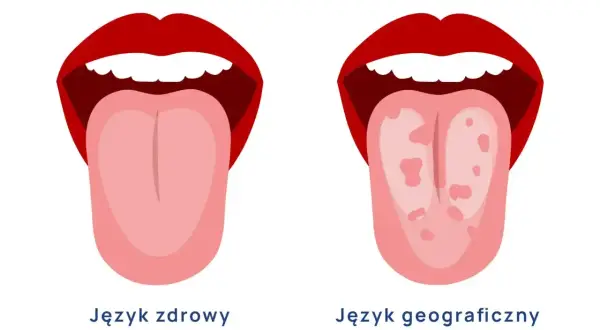 Dwa języki: zdrowy, gładki i język geograficzny z plamkami.