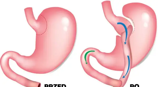 Operacja zmniejszenia żołądka nfz gdzie - sprawdź najlepsze ośrodki