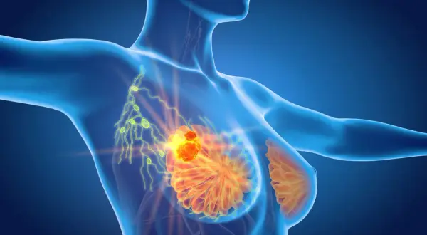 Anatomical rendering showing a tumor in the breast and enlarged lymph nodes in the armpit, indicating potential spread and causing ból pod pachą.