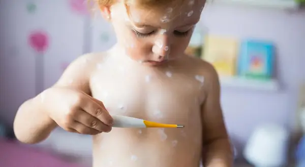 Jakie leki na ospę wietrzną skutecznie łagodzą objawy choroby?