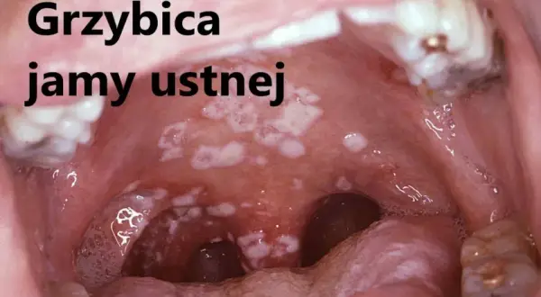 Skuteczne leki na grzybicę jamy ustnej - uniknij bólu i dyskomfortu