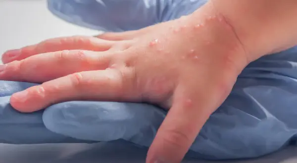 Dziecięca dłoń z licznymi pęcherzykami, objawem wysypki alergicznej, spoczywa na niebieskiej rękawiczce.