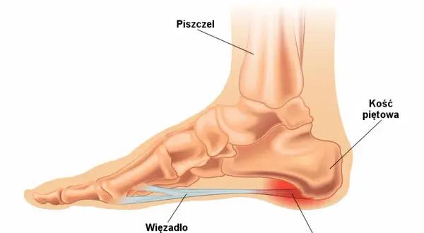 Jakie leki na ostrogę piętową skutecznie złagodzą ból?