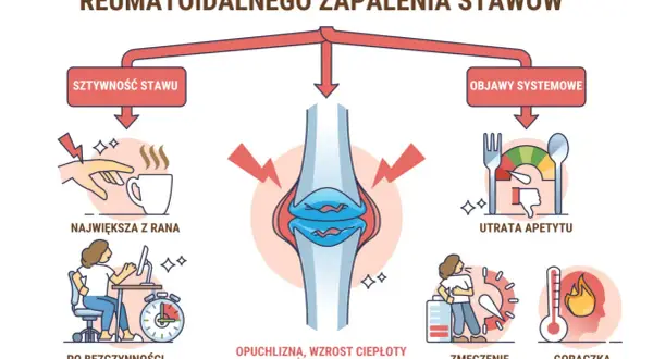 Wczesne oznaki rzs: sztywność stawu (największa z rana, po bezczynności), opuchlizna, utrata apetytu, zmęczenie, gorączka.