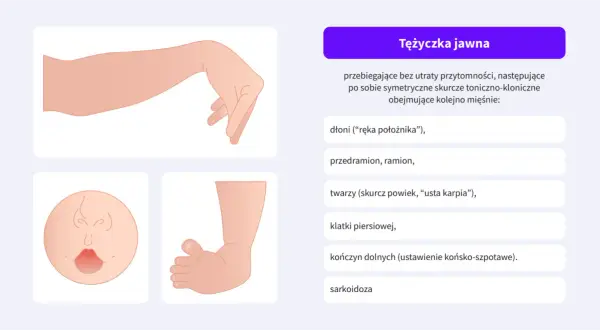 Ilustracja pokazuje tężyczkę jawną, objawy obejmują dłoń jak u położnika, skurcze twarzy i kończyn.