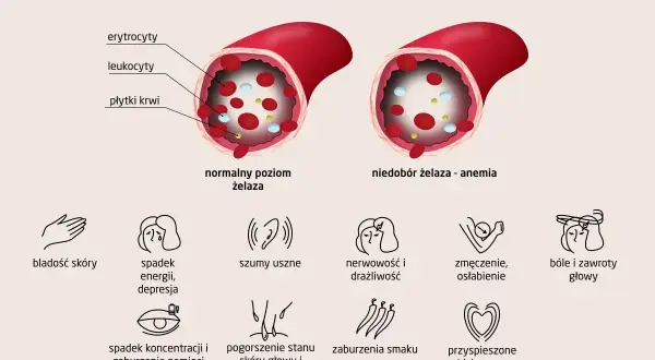 Anemia objawy: bladość skóry, spadek energii, szumy uszne, nerwowość, zmęczenie, bóle głowy, spadek koncentracji, pogorszenie stanu skóry i wypadanie włosów, zaburzenia smaku, przyspieszone bicie serca.