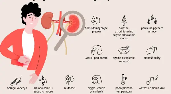 Ilustracja przedstawia objawy zapalenia nerek: ból pleców, problemy z oddawaniem moczu, obrzęki, nudności, gorączkę i inne.