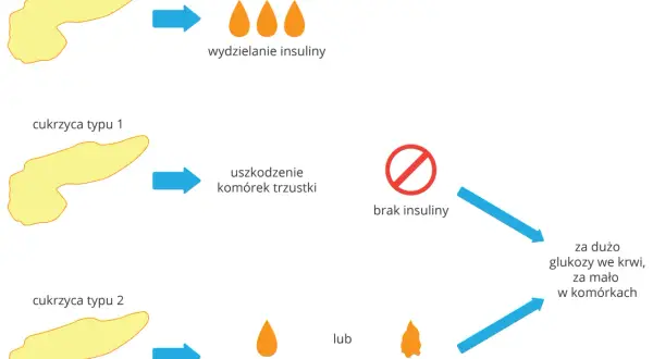 Schemat porównuje zdrową trzustkę wydzielającą insulinę z cukrzycą typu 1 (brak insuliny) i typu 2 (mała ilość lub nieprawidłowe działanie insuliny), co prowadzi do problemów z glukozą.