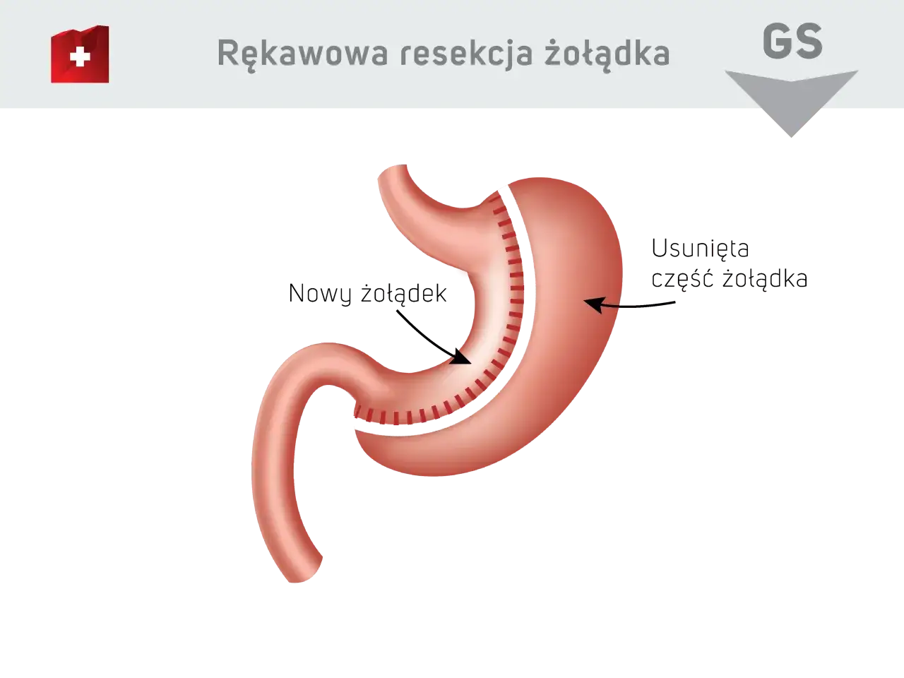 Zdjęcie Operacja zmniejszenia żołądka nfz gdzie - sprawdź najlepsze ośrodki