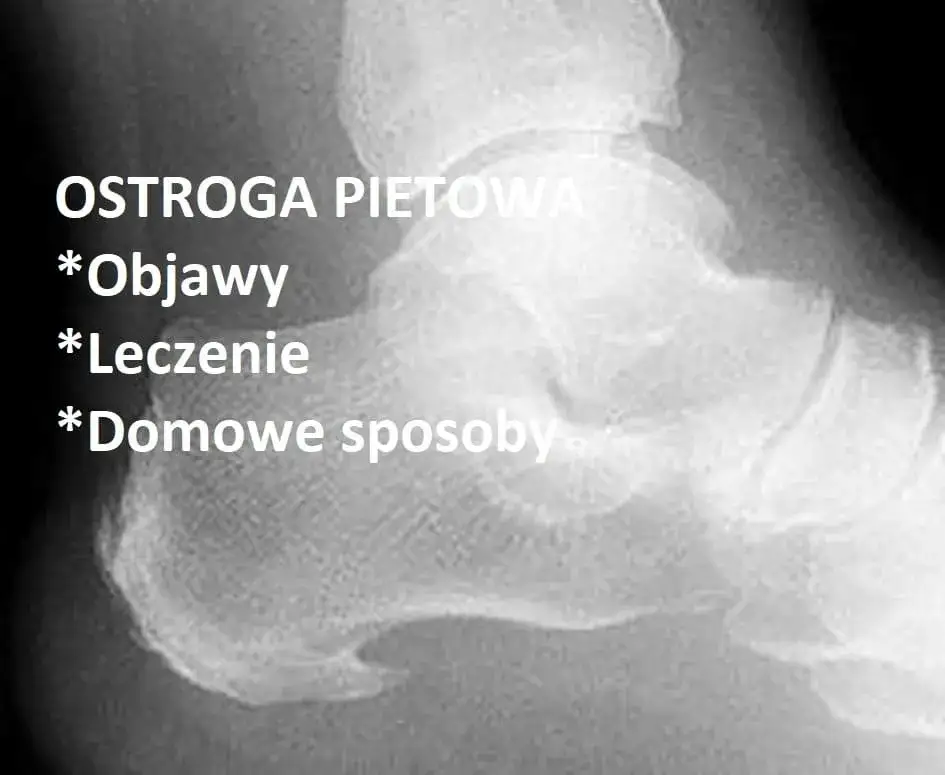 Zdjęcie Jakie leki na ostrogę piętową skutecznie złagodzą ból?