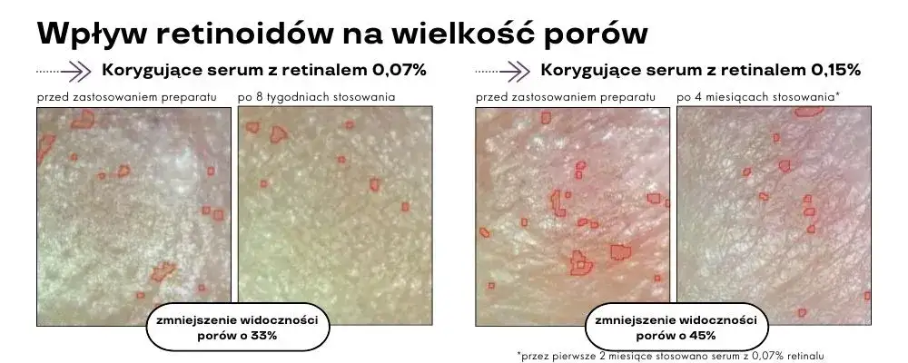Zdjęcie Retinol lek na co? Odkryj jego skutki i zastosowania w terapii skóry