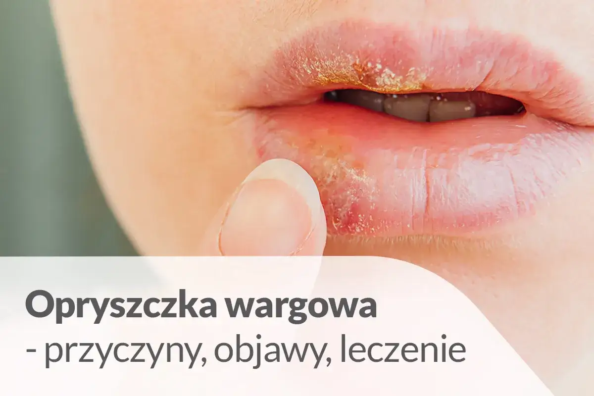 Zbliżenie na usta z widoczną opryszczką wargową. Palec delikatnie dotyka zmiany.