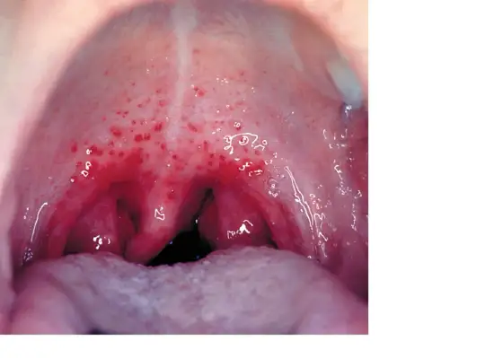 Streptococcus pyogenes - Angina, szkarlatyna, sepsa? Rozpoznaj!