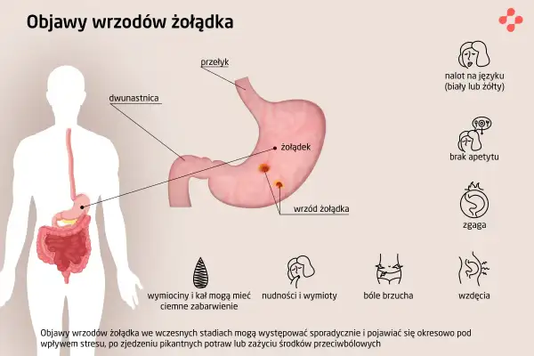Ilustracja przedstawia objawy wrzodów żołądka: nalot na języku, brak apetytu, zgaga, bóle brzucha, wzdęcia, wymioty.