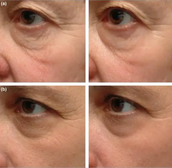 Retinol lek na co? Odkryj jego skutki i zastosowania w terapii skóry