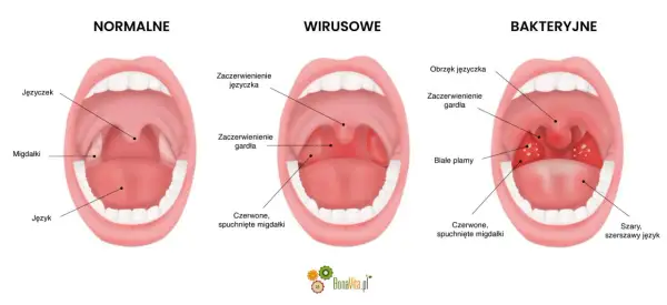 Porównanie gardła: normalne, wirusowe i bakteryjne. Czy angina jest zaraźliwa? Obraz pokazuje różnice w wyglądzie migdałków i gardła przy infekcjach.